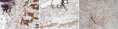 CDKN2A and MTAP Are Useful Biomarkers Detectable by Droplet Digital PCR in Malignant Pleural Mesothelioma: A Potential Alternative Method in Diagnosis Compared to Fluorescence In Situ Hybridisation